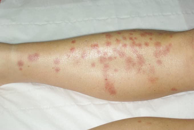 Boutons de punaises de lit n°1