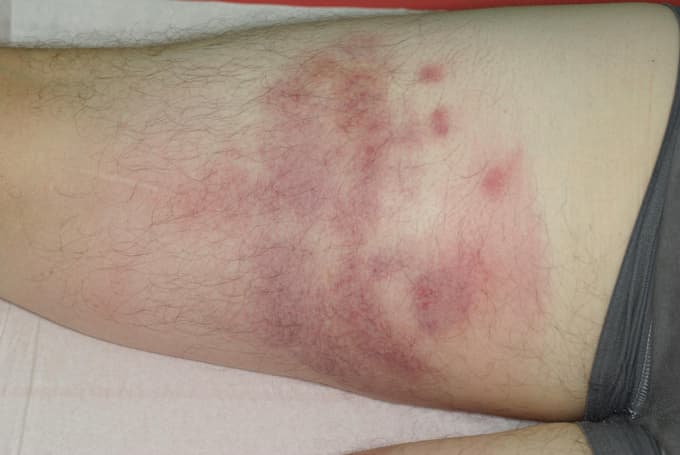 Boutons de punaises de lit n°2