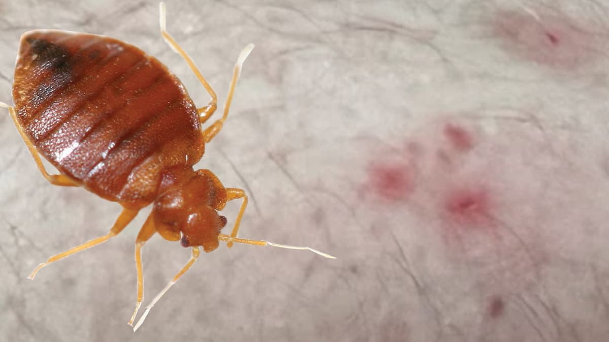 Punaise de lit et piqure provoquée sur une jambe